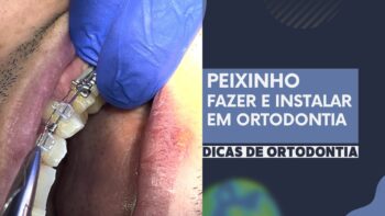 Peixinho em Ortodontia: O que é, Como Fazer e Instalar