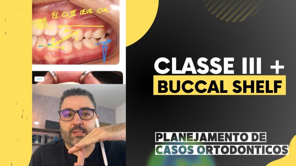 buccal shelf