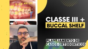 Evite Erros no Tratamento da Classe III com Buccal Shelf