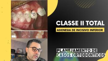 Tratamento Ortodôntico da Classe II Total com Agenesia dos Incisivos Centrais Inferiores