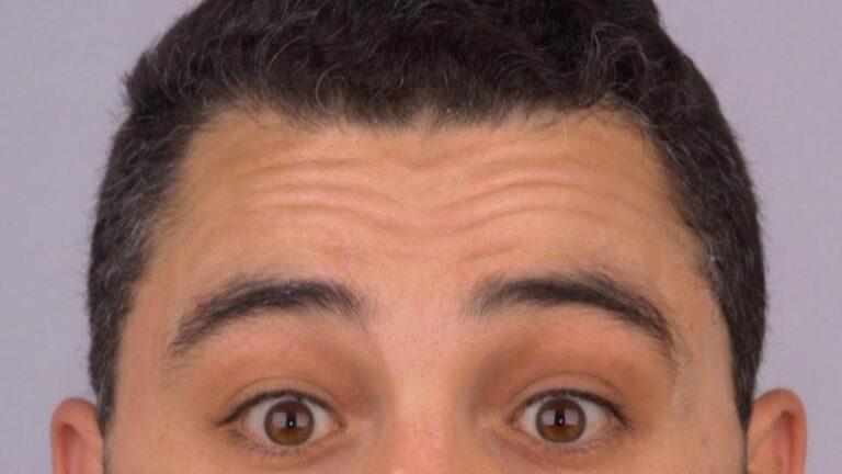 botox homem testa botucatu antes e depois1