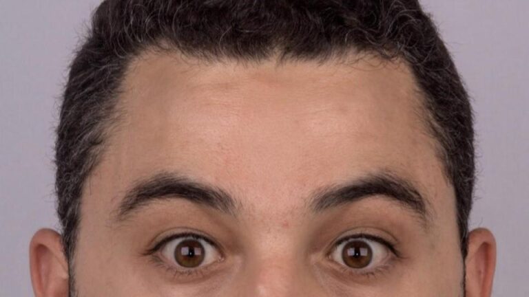 botox masculino testa antes e depois