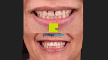 Implante Dentário Antes e Depois: Resultados Reais em Botucatu – SP